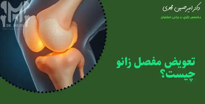 تعویض مفصل زانو چیست؟