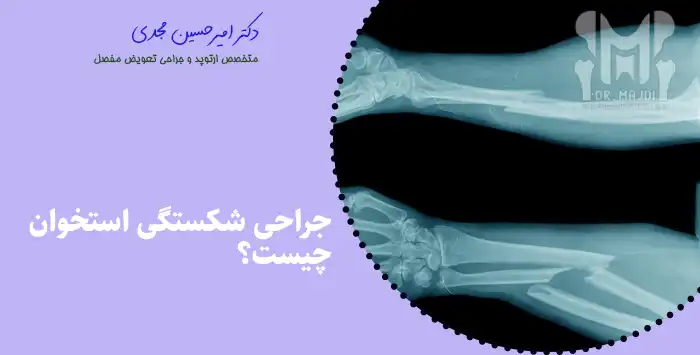 جراحی شکستگی استخوان چیست؟