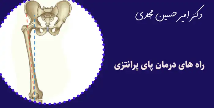 راه های درمان پای پرانتزی