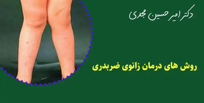 روش های درمان زانوی ضربدری
