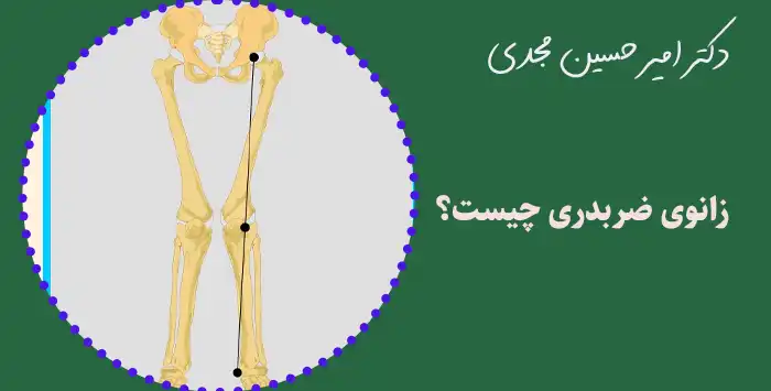 زانوی ضربدری چیست؟