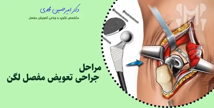 مراحل جراحی تعویض مفصل لگن