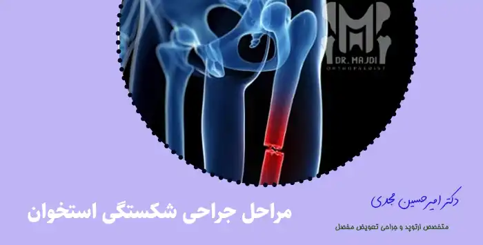 مراحل جراحی شکستگی استخوان