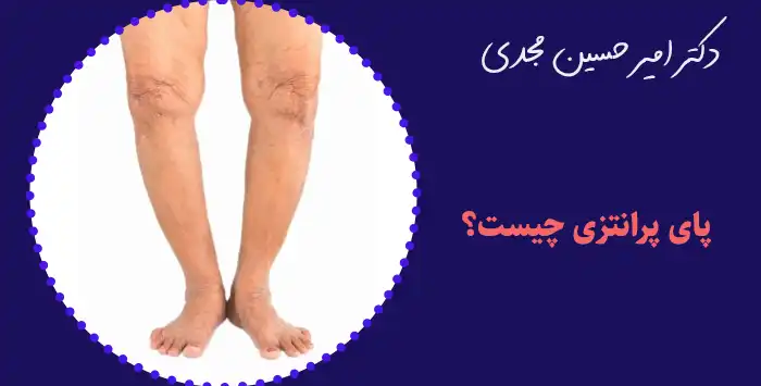 پای پرانتزی چیست؟