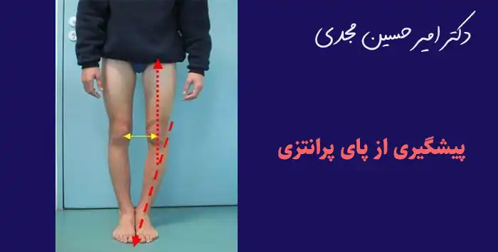 پیشگیری از پای پرانتزی