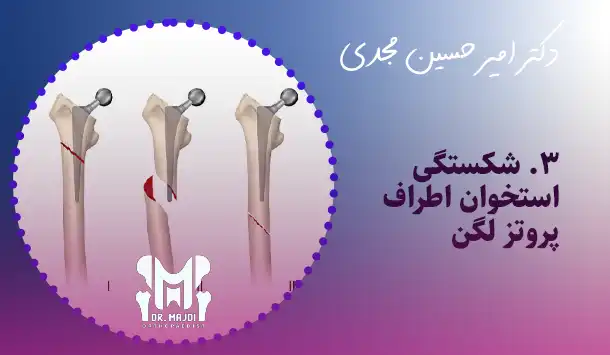 شکستگی استخوان اطراف پروتز لگن