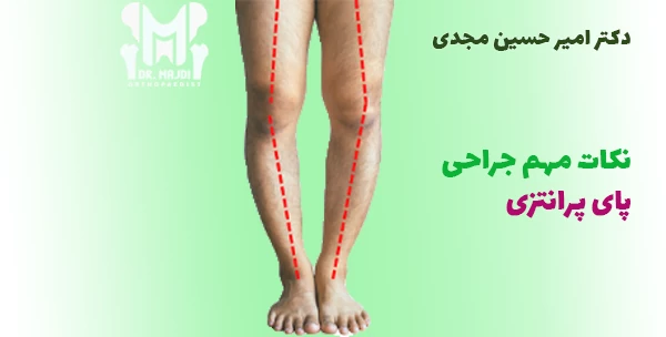 نکات مهم جراحی پای پرانتزی