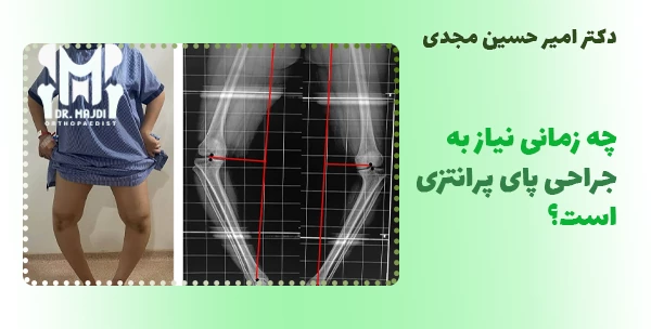 چه زمانی نیاز به جراحی پای پرانتزی است؟