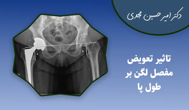 تاثیر تعویض مفصل لگن بر طول پا