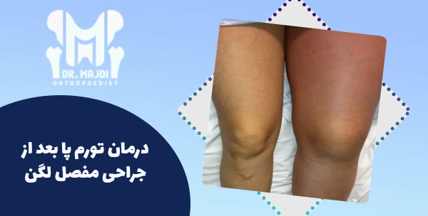 درمان تورم پا بعد از جراحی مفصل لگن