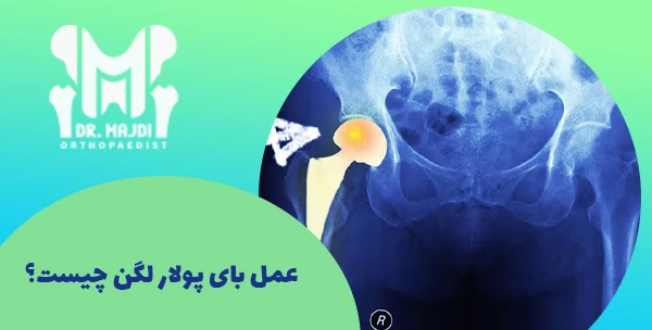 عمل بای پولار لگن چیست؟