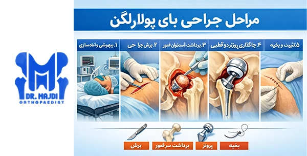 مراحل جراحی بای پولار لگن