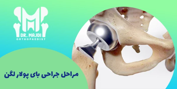 مراحل جراحی بای پولار لگن