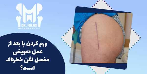 ورم کردن پا بعد از عمل تعویض مفصل لگن خطرناک است؟