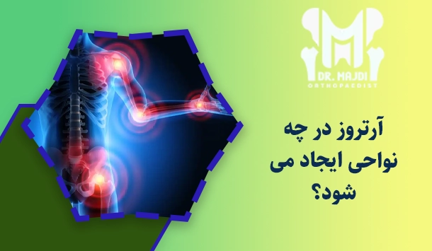 آرتروز در چه نواحی ایجاد می شود؟