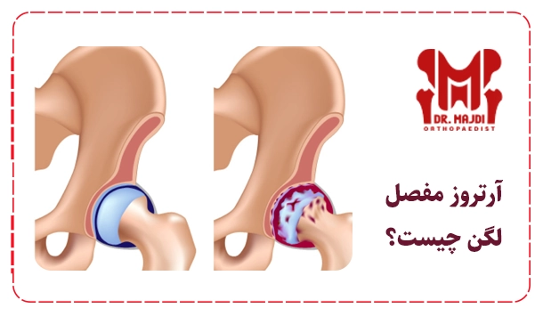 آرتروز مفصل لگن چیست؟