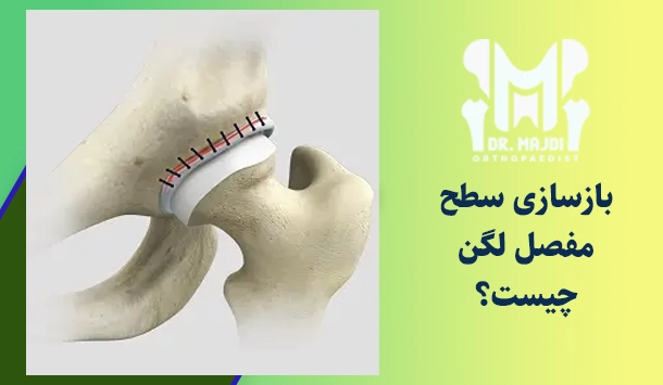 بازسازی سطح مفصل لگن چیست؟