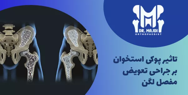 تاثیر پوکی استخوان بر جراحی تعویض مفصل لگن