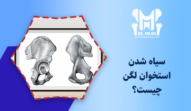 سیاه شدن استخوان لگن چیست؟