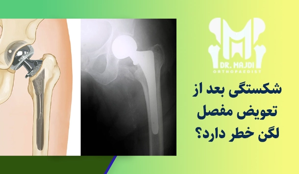 شکستگی بعد از تعویض مفصل لگن خطر دارد؟