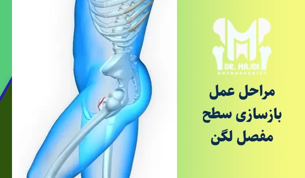 مراحل عمل بازسازی سطح مفصل لگن
