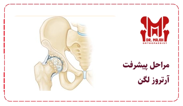 مراحل پیشرفت آرتروز لگن