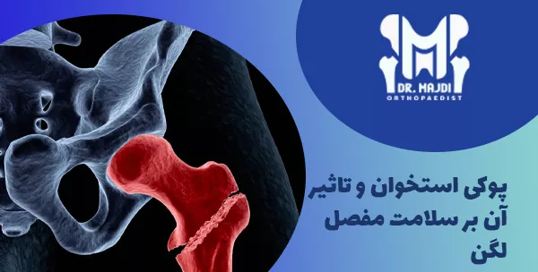 پوکی استخوان و تاثیر آن بر سلامت مفصل لگن