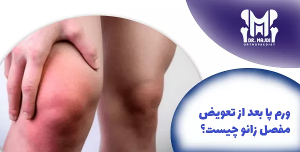 ورم پا بعد از تعویض مفصل زانو چیست؟