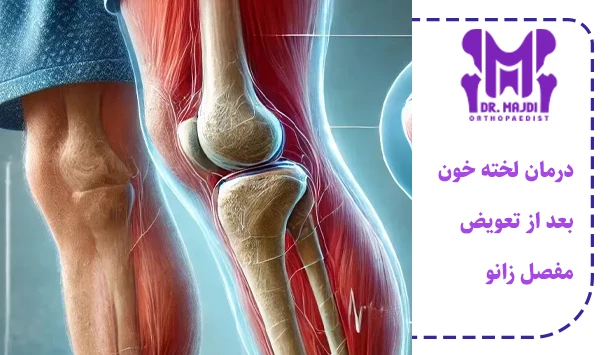 درمان لخته خون بعد از تعویض مفصل زانو
