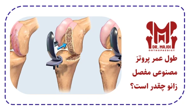 طول عمر پروتز مصنوعی مفصل زانو چقدر است؟