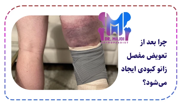 چرا بعد از تعویض مفصل زانو کبودی ایجاد می‌شود؟