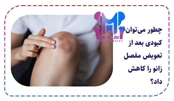 چطور می‌توان کبودی بعد از تعویض مفصل زانو را کاهش داد؟