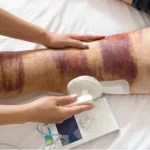 کبودی بعد از تعویض مفصل زانو