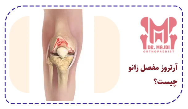 آرتروز مفصل زانو چیست؟