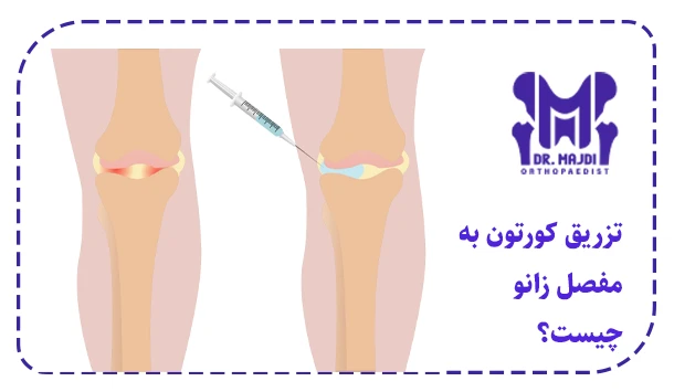 تزریق کورتون به مفصل زانو چیست؟
