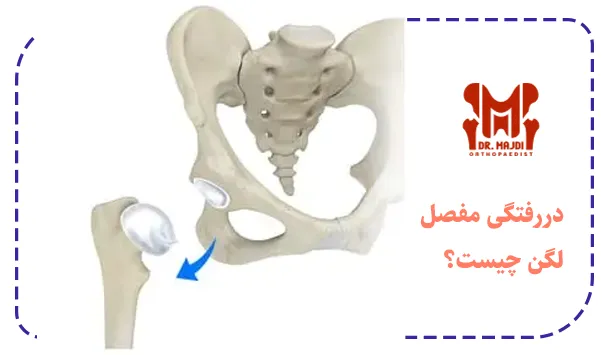 دررفتگی مفصل لگن چیست؟