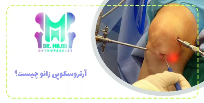 آرتروسکوپی زانو چیست