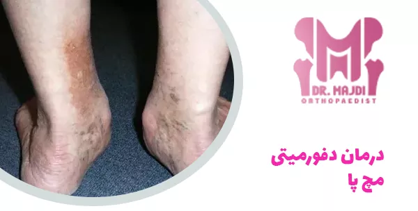 درمان دفورمیتی مچ پا
