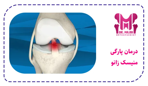 درمان پارگی منیسک زانو