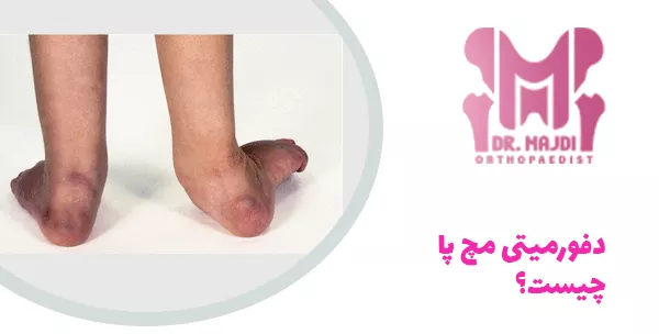 دفورمیتی مچ پا چیست؟