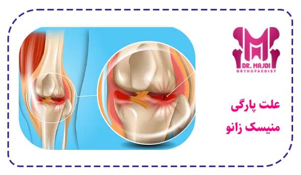 علت پارگی منیسک زانو 