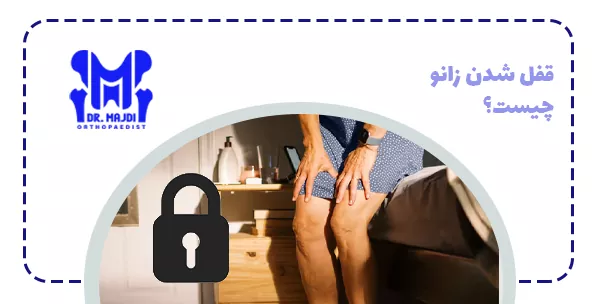 قفل شدن زانو چیست؟