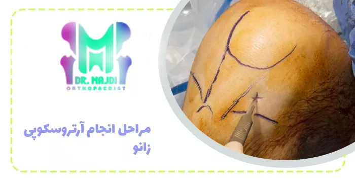 مراحل آرتروسکوپی زانو