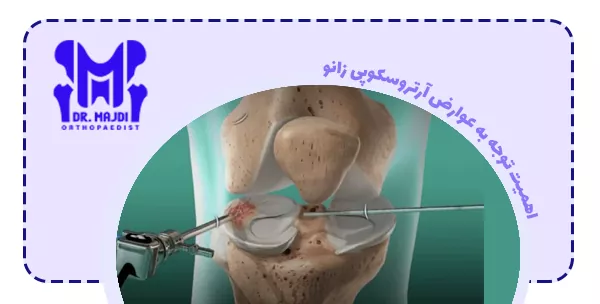 اهمیت توجه به عوارض آرتروسکوپی زانو