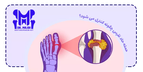 حمله حاد نقرس چگونه کنترل می شود؟