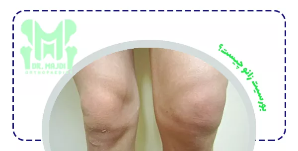 بورسیت زانو چیست؟