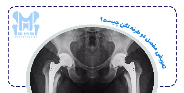 تعویض مفصل دو طرفه لگن چیست؟