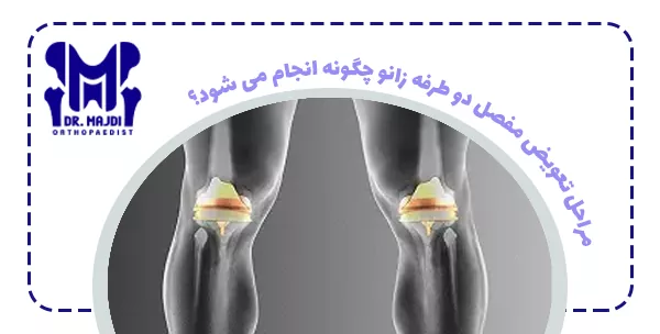 مراحل تعویض مفصل دو طرفه زانو چگونه انجام می شود؟