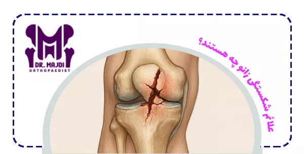 علائم شکستگی زانو چه هستند؟