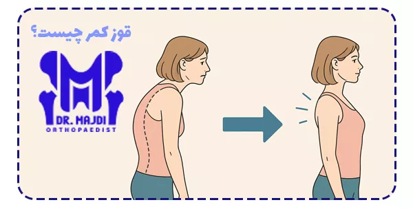 قوز کمر چیست؟
